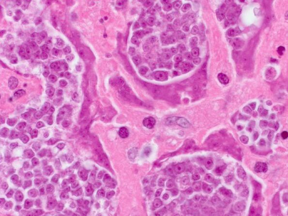 Suche nach Parasiten in einer Person